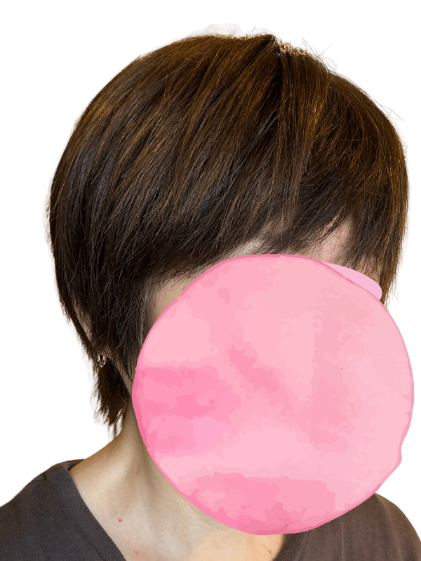 医療美容師のカット後のヘアピース装着・横から