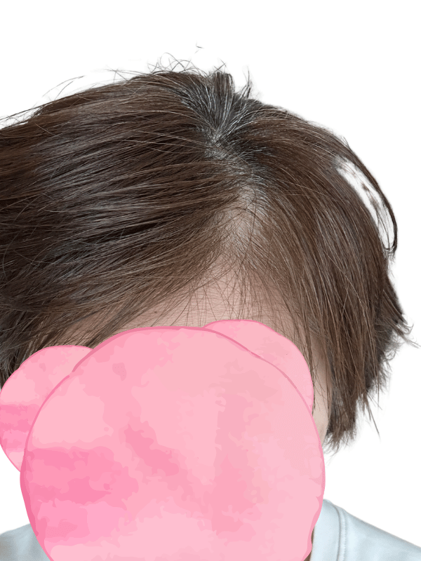 ヘアピース装着なしの頭頂部。分け目に白髪が見える状態