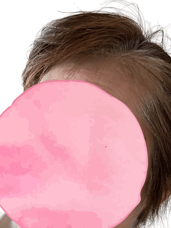 ヘアピース装着なしの生え際(横から)